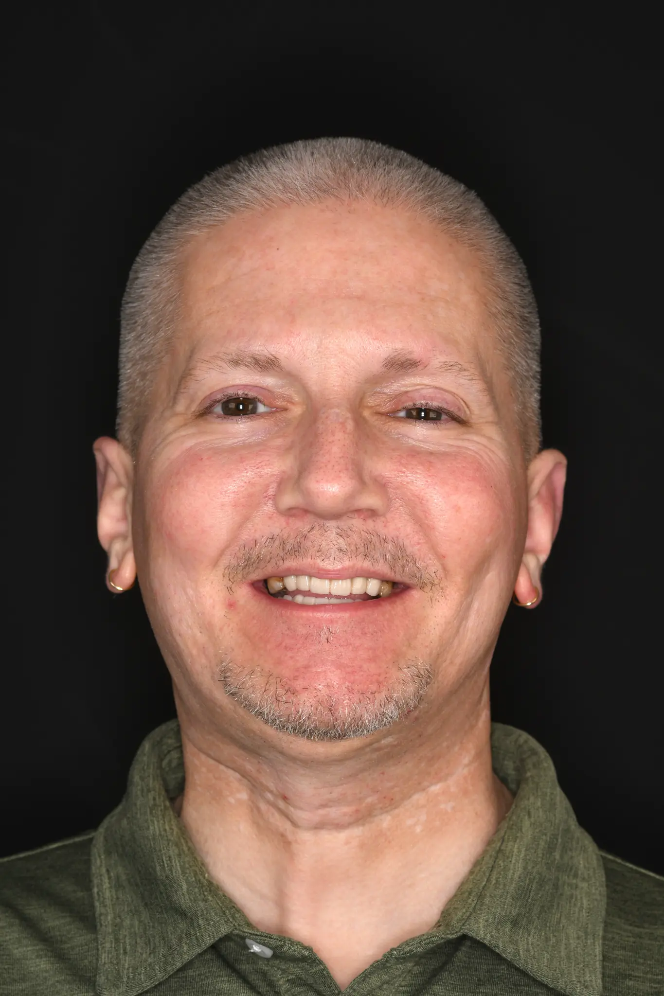 Alex after implant treatment with Dr. Constantine