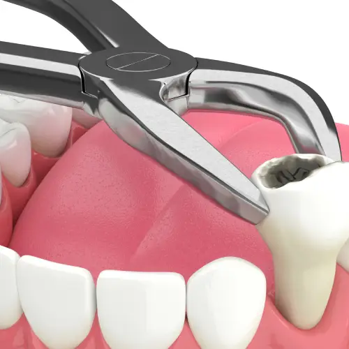 Illustration of forceps gripping a decayed lower molar during extraction