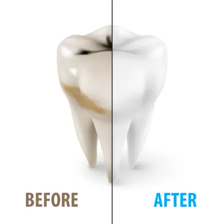 Molar shown before and after, stained grooves and a clean, protected surface
