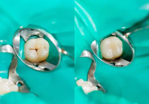 Molar before and after a sealant fills its grooves