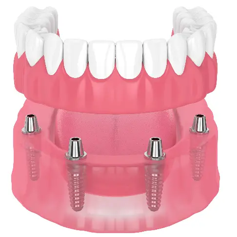 Illustration of a removable overdenture that snaps onto four dental implants