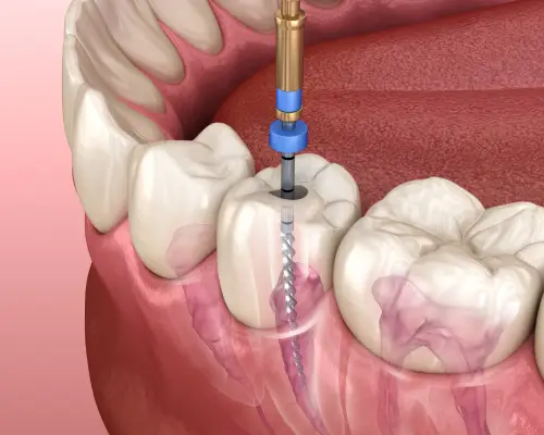 Illustration of a root canal file cleaning the canal of a lower molar