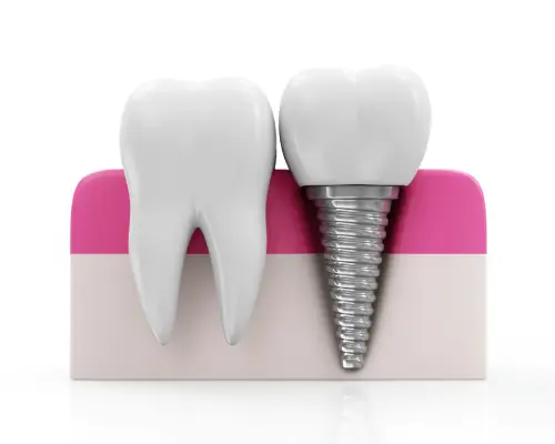 Model of a natural tooth beside a dental implant with a crown