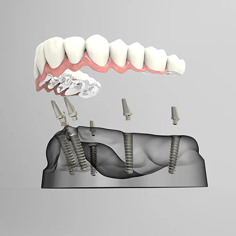 3D model of a full prosthetic arch above four angled implants in the jawbone