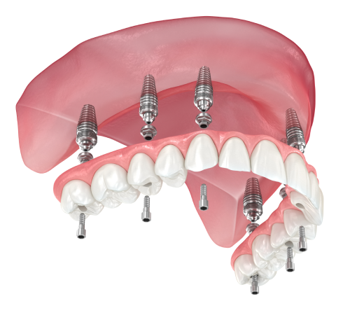 Illustration of a full upper arch of teeth attached to six dental implants