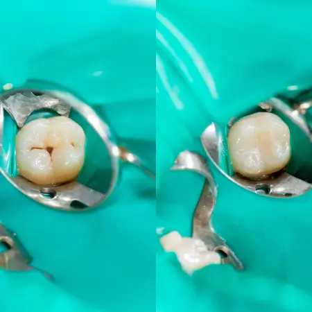Molar with deep grooves before and after a dental sealant is applied