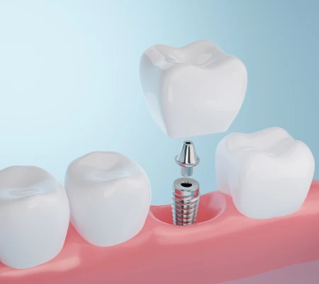 Illustration of a narrow mini dental implant post