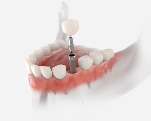 Illustration of a dental implant post, abutment and crown in the jaw