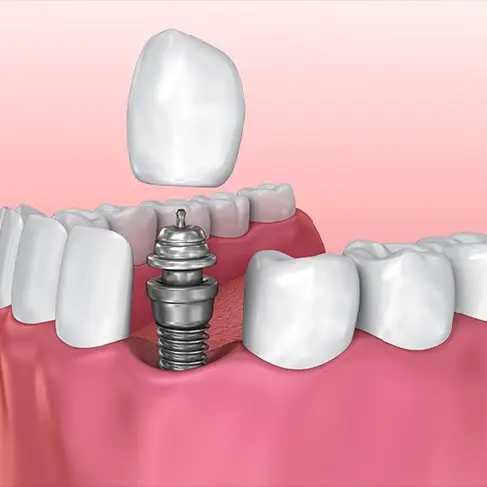 Everything You Need to Know on Dental Crowns