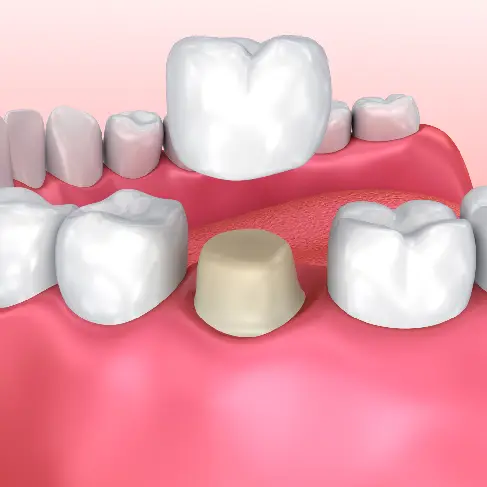How Long Do Crowns Last on Front Teeth_ Everything You Need to Know (1)
