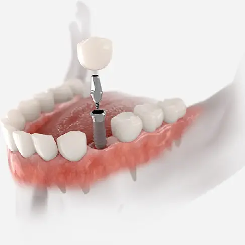 Dental Implants in Towson, MD