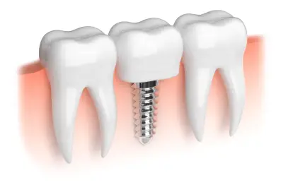 Are Dental Implants Painful_ What Patients Should Know