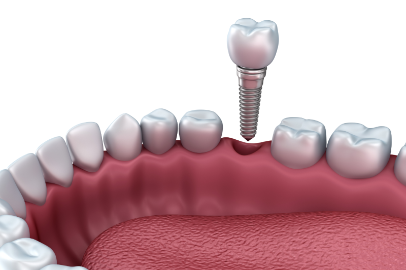 Are Dental Implants Safe?