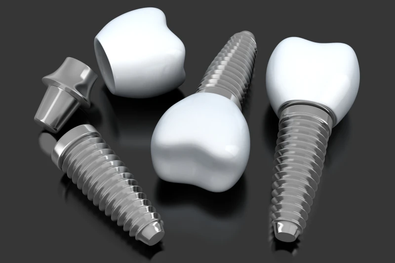 What Are Screwless Dental Implants?
