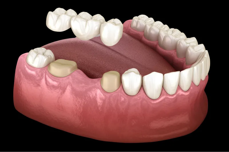 How Much Does a Dental Bridge Cost_