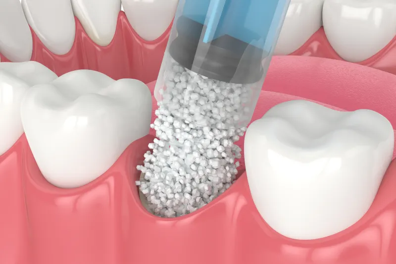 What Is a Dental Bone Graft_ Procedure, Types & Healing
