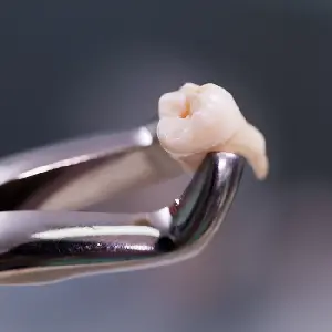 3-Reasons-You-May-Need-a-Tooth-Extraction