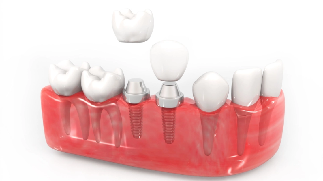 Alternatives to Dental Implants: What Are Your Best Options?