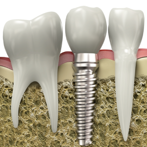 Are-Dental-Implants-Safe