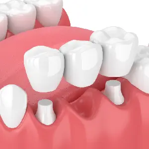 Dental-Bridge