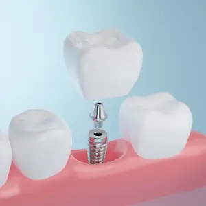 How-Dental-Implants-Work-and-What-to-Expect