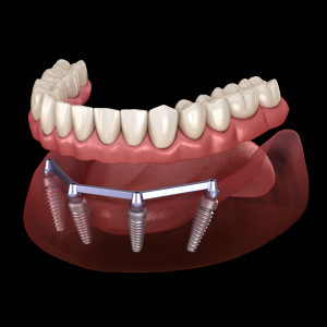 How Long Does It Take to Heal After All-on-4 Dental Implants