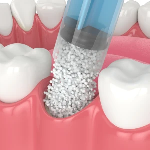 How-Long-Does-a-Dental-Bone-Graft-Take-to-Heal