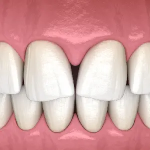The-Effect-of-Gaps-in-Teeth