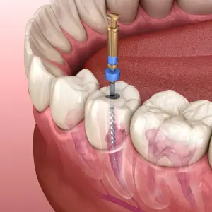 The-Root-Canal-Procedure-2