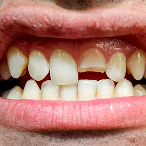 Tooth-Decay