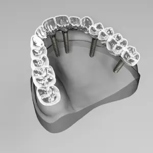 Understanding-What-Dental-Implants-Are