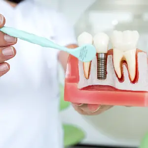 What-Are-Dental-Implants