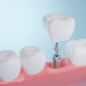 What-Does-Screwless-Dental-Implant-Mean