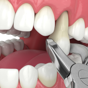 What-Happens-After-a-Tooth-Extraction