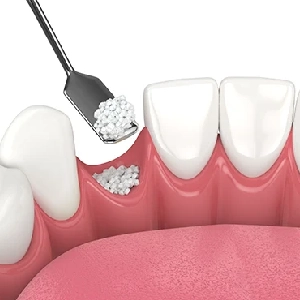 What-Happens-During-Bone-Graft-Healing