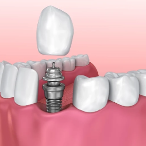 Why-Consider-Alternatives-to-Dental-Implants