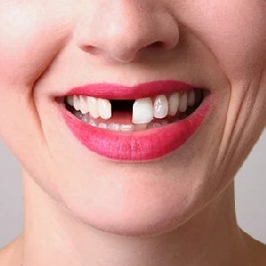 Why-Replacing-a-Missing-Tooth-Matters