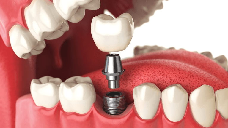 Diagram of dental implant replacing tooth in Towson, MD