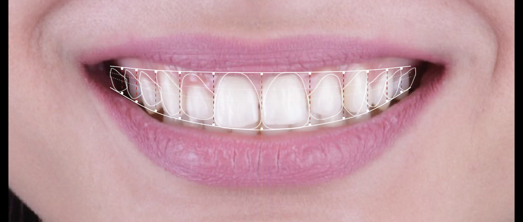 Close up of digital smile design at dentist in Towson MD