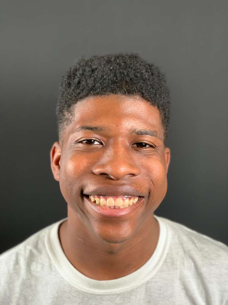 Patient's teeth after single-visit veneers procedure in Towson, MD