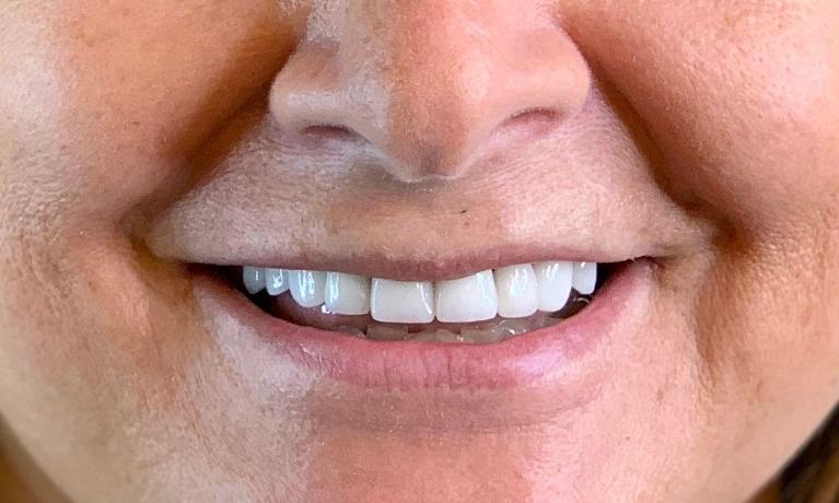 Results from dental implant placement in Towson MD