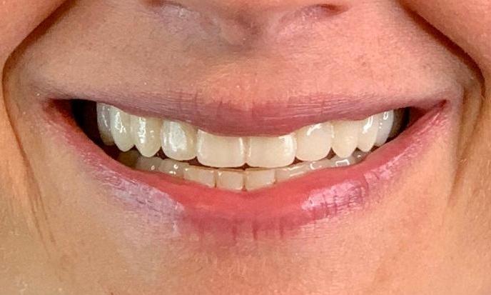 Results from dental crowns and veneers in Towson MD