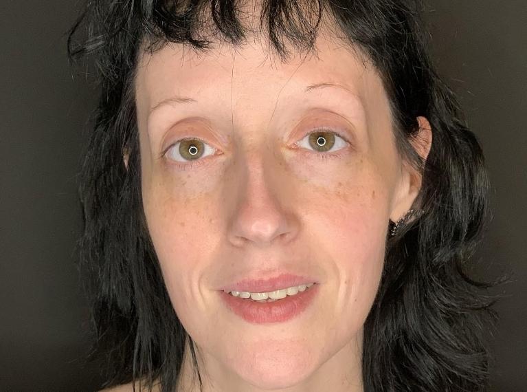 Patients smile with dental implants in Towson MD