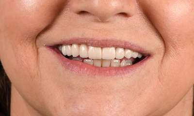 Upper-Implants-All-on-X-After-Image