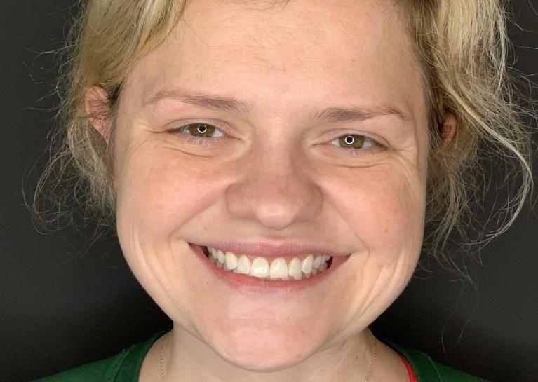 Veneers-and-Porcelain-Crowns-After-Image