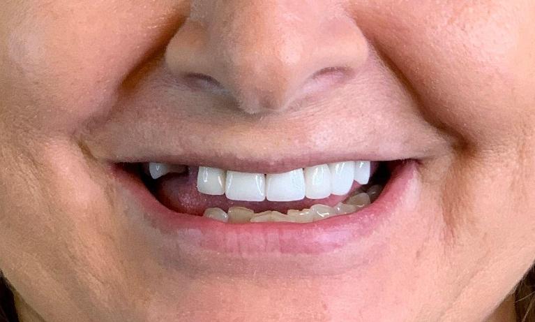 Patient with missing tooth at dentist in Towson MD