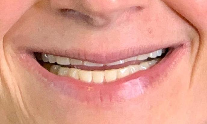 Patient with worn down teeth at dentist in Towson MD