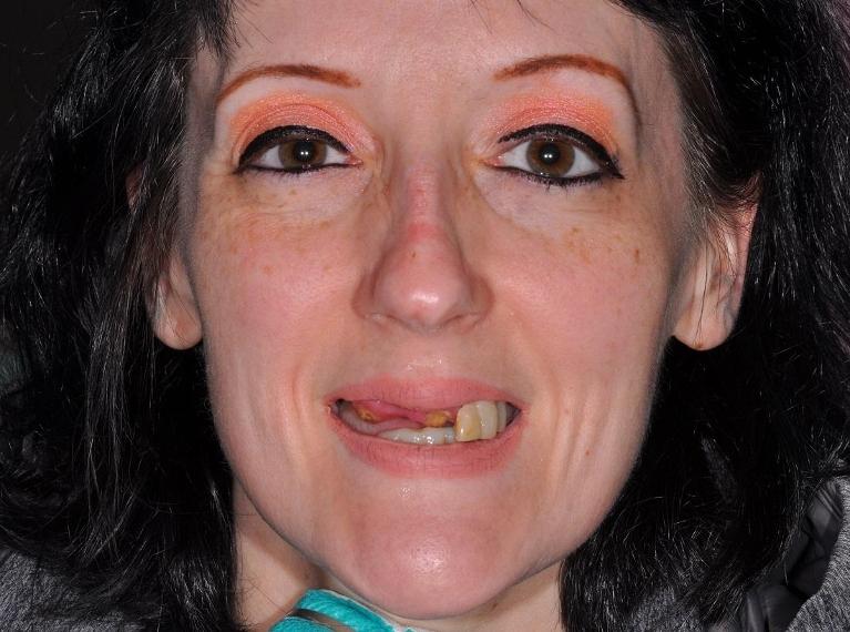 Patient with missing teeth at dentist in Towson MD