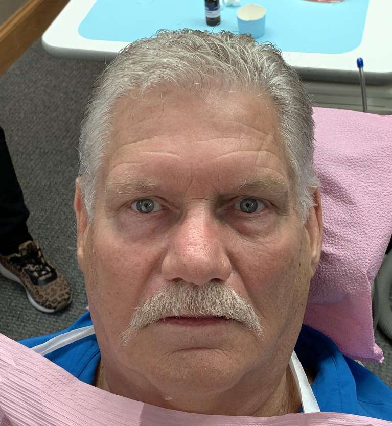 Upper-Complete-Implant-Rehabilitation-Before-Image
