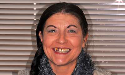 Upper-Implants-All-on-X-Before-Image